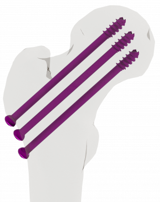 Cannulated_Screws_B