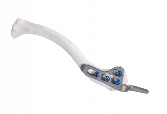 Clavilcle-hook_AF-Medical_164
